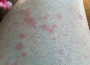 天津湿疹皮肤瘙痒怎么办