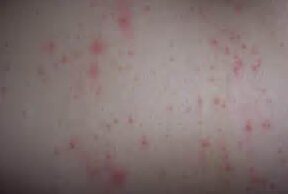 荨麻疹要怎么治疗
