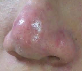 针对酒糟鼻的预防措施主要有哪些